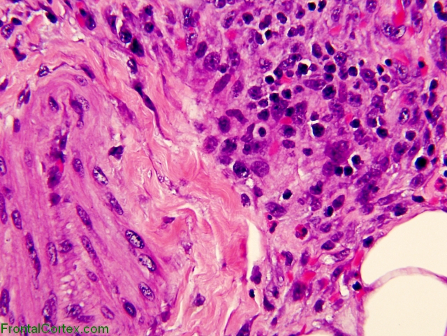 Perivascular infiltrate, H&E stained paraffin embedded section x400